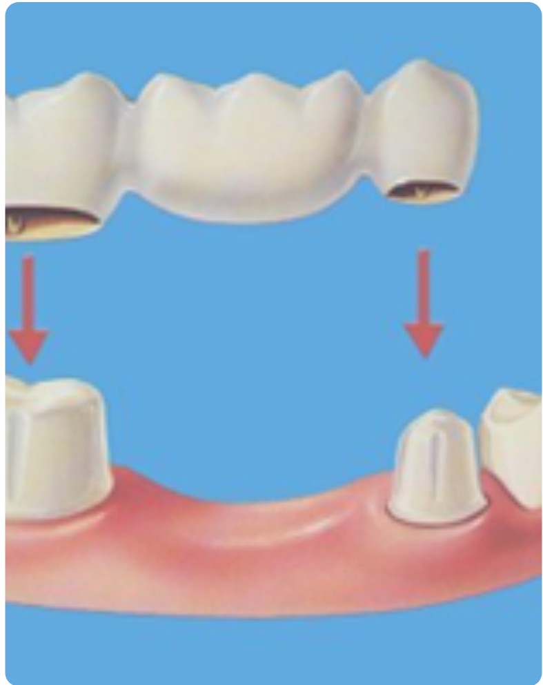 Major Restorative